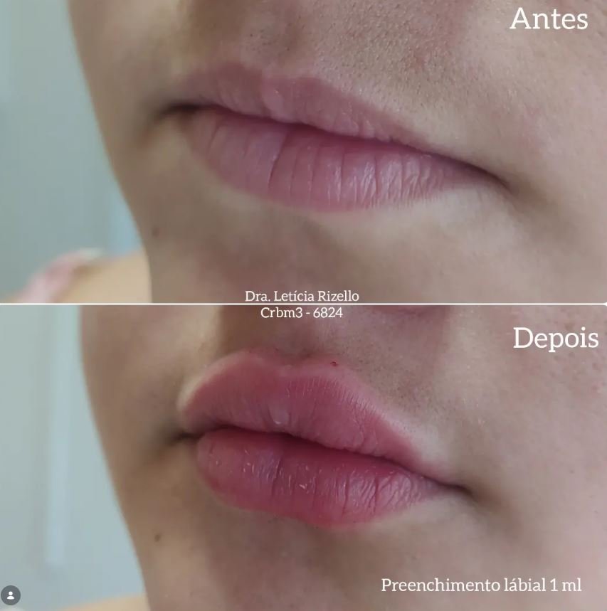 Registro visual de antes e depois de procedimento estético — imagem 4